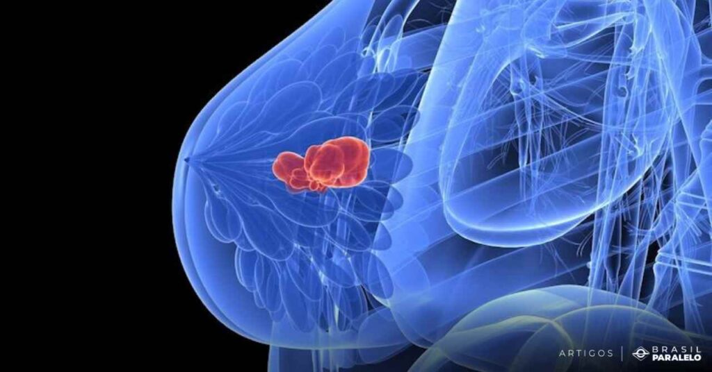 O-aborto-e-uma-das-principais-causas-de-cancer-de-mama