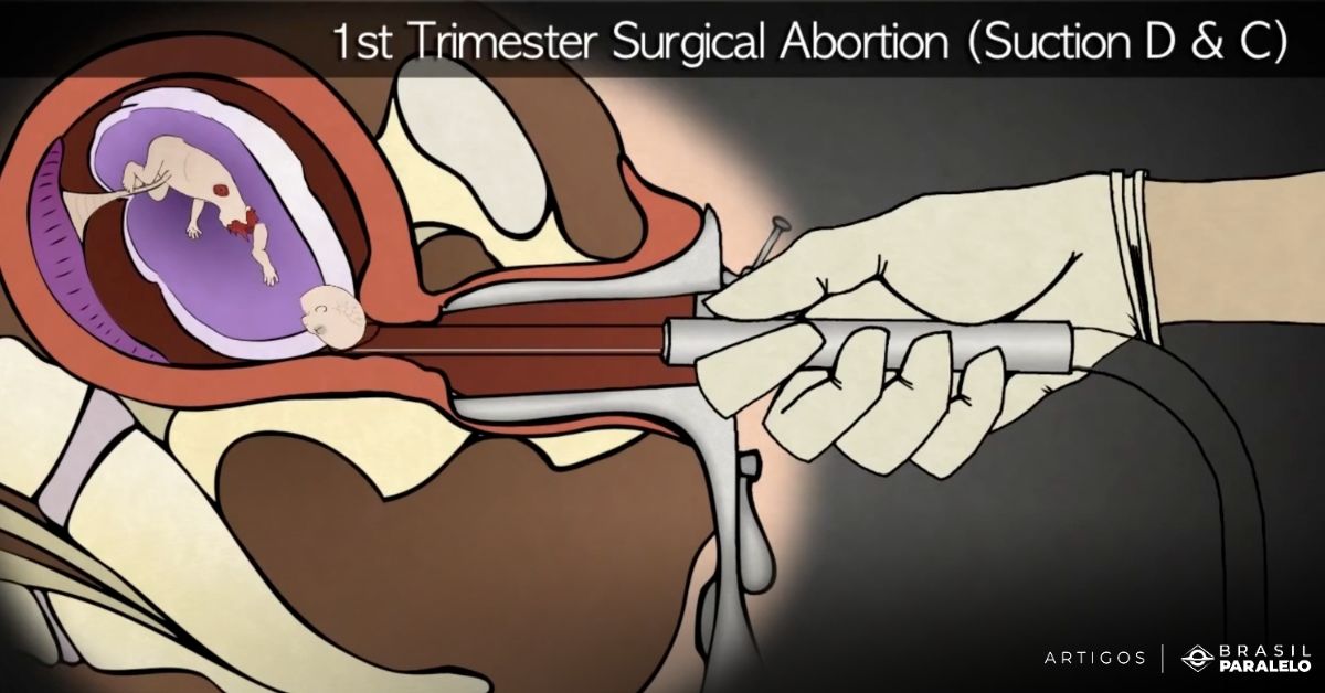 aborto-aspiração-intrauterina