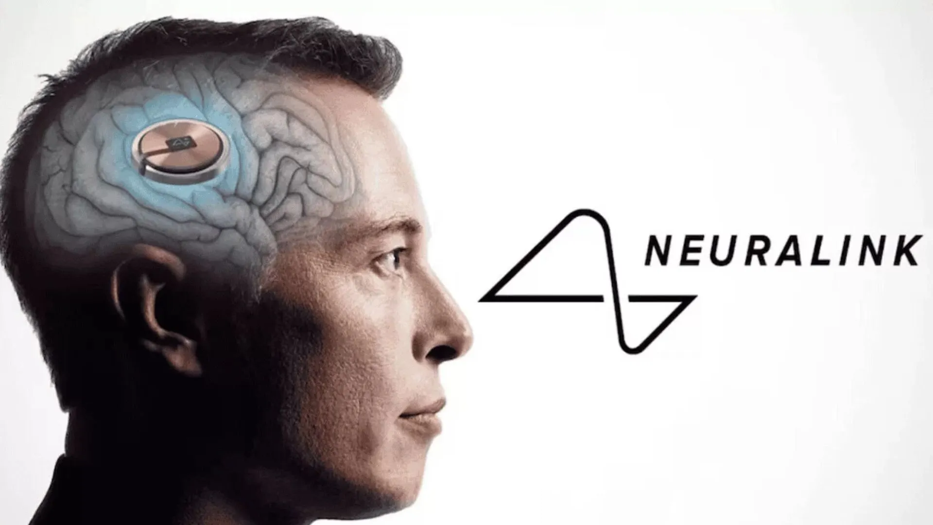 Paciente com ELA volta a se comunicar após implante da Neuralink | Brasil Paralelo